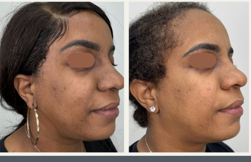 Laser CO₂ fractionné – Visage complet